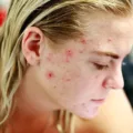 How Do I Contact Curology Customer Service? 4 acne