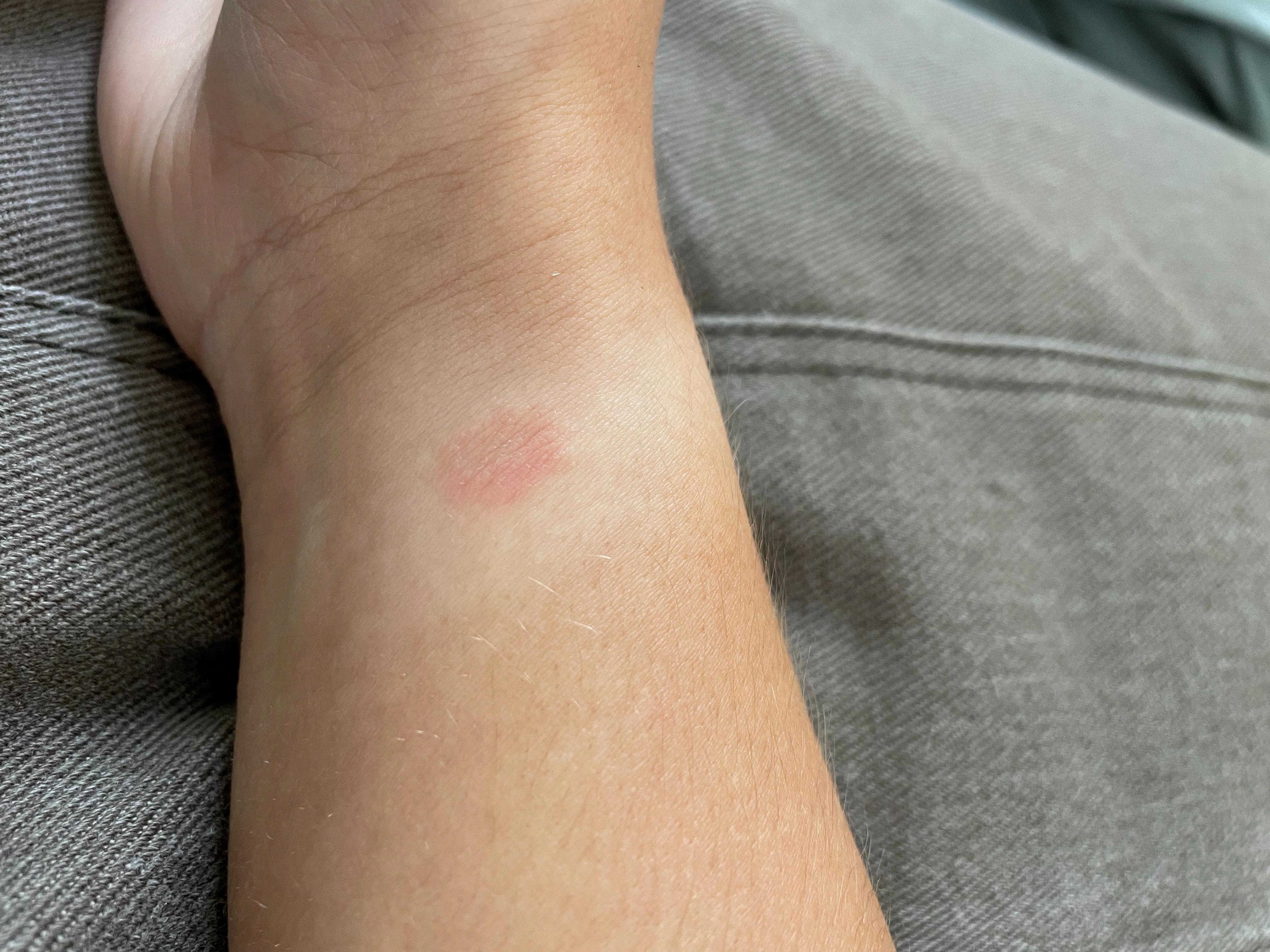 apple watch rash apple watch rash