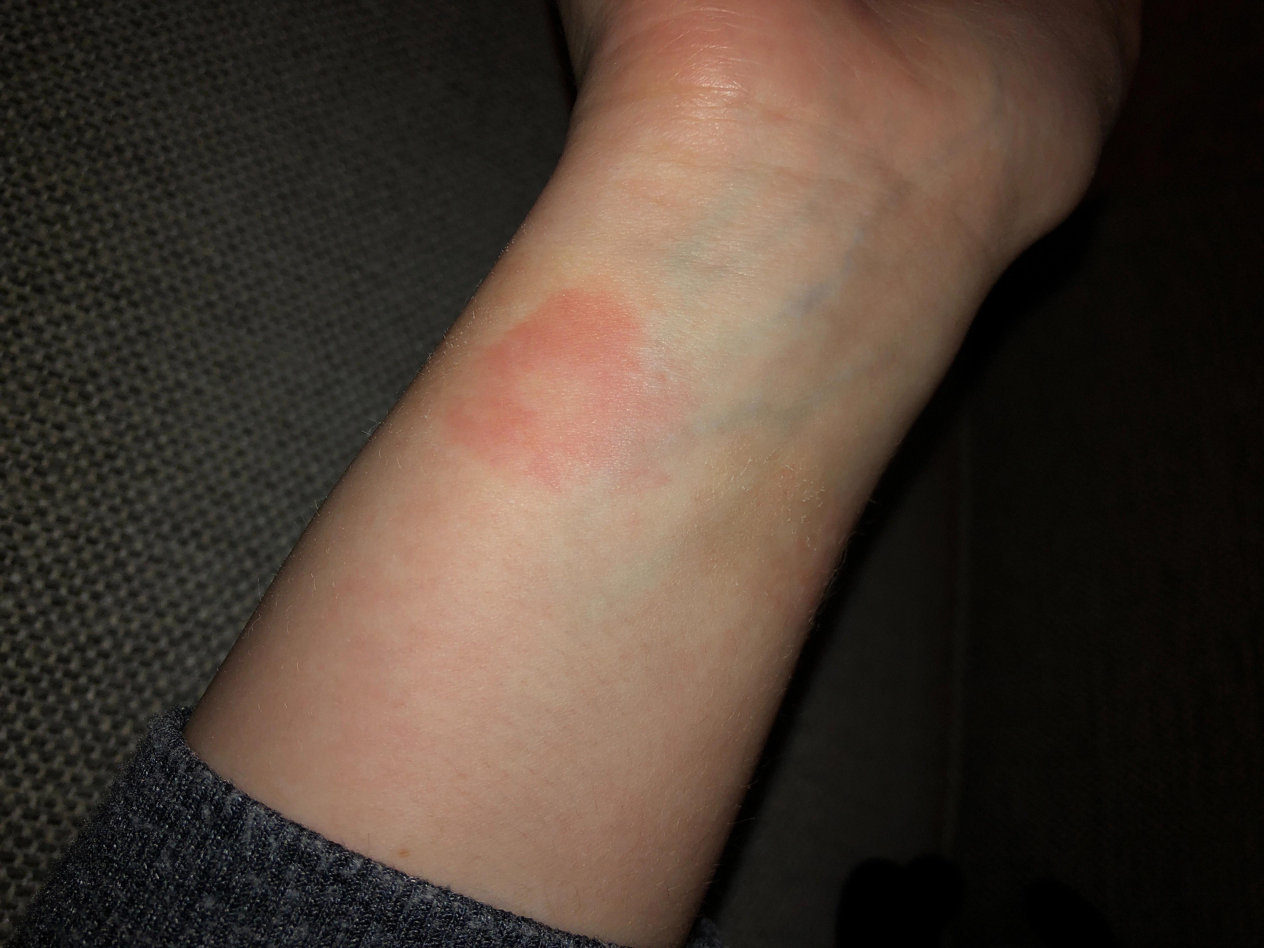 apple watch rash apple watch rash