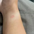 Why Do I Get A Rash After Wearing My Apple Watch ? 14 Why Do I Get A Rash After Wearing My Apple Watch ? 13